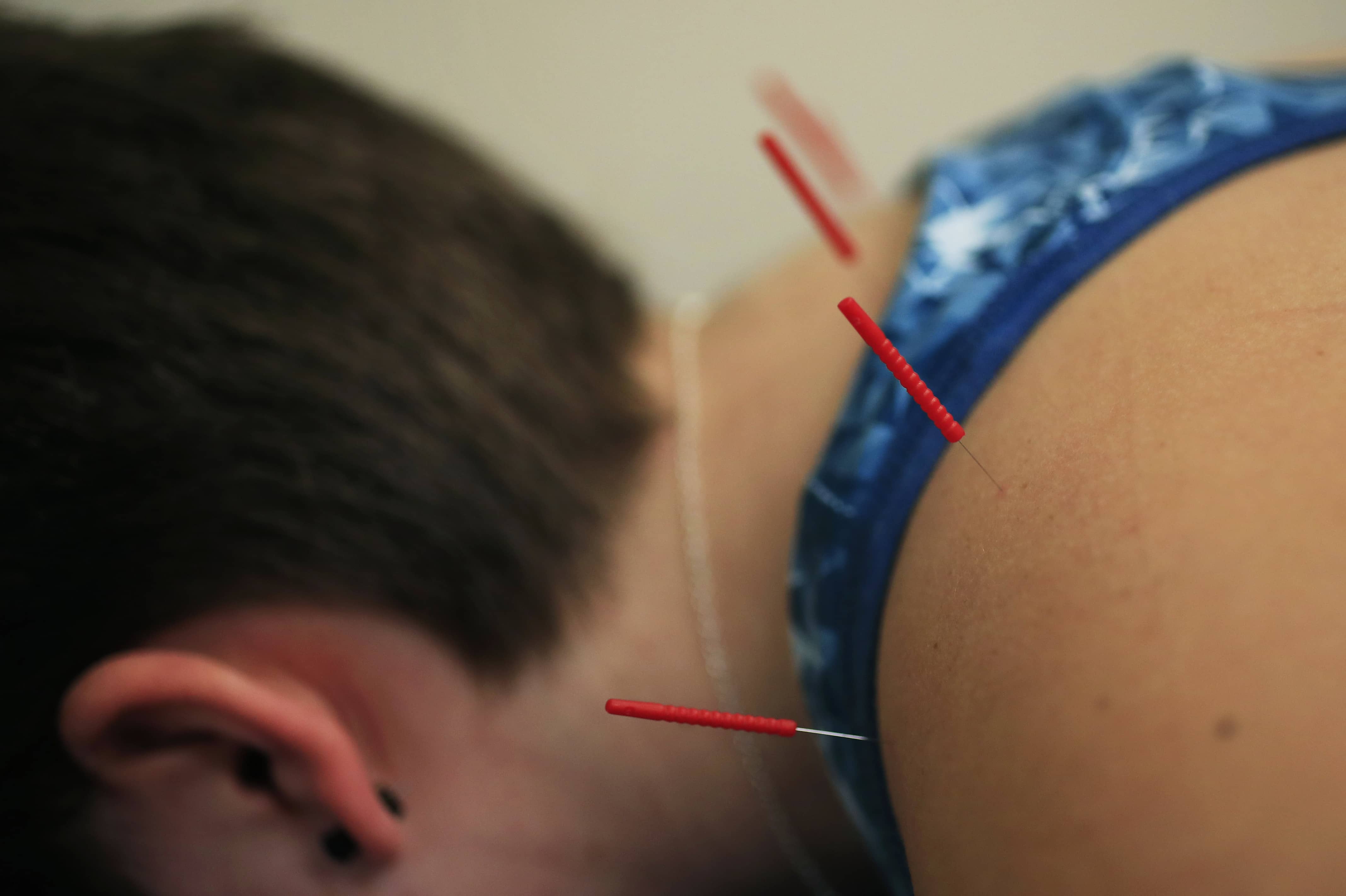 Acupuncture needles are applied on Sarah Taylor's back during an acupuncture treatment at the Children's National Medical Center in Washington