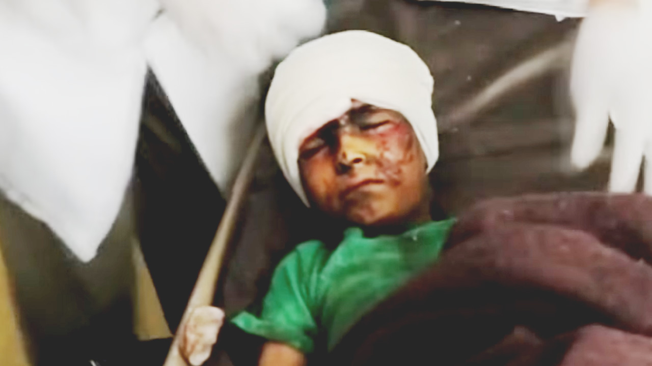 Photo of Yemeni child injured in Saudi-led airstrike