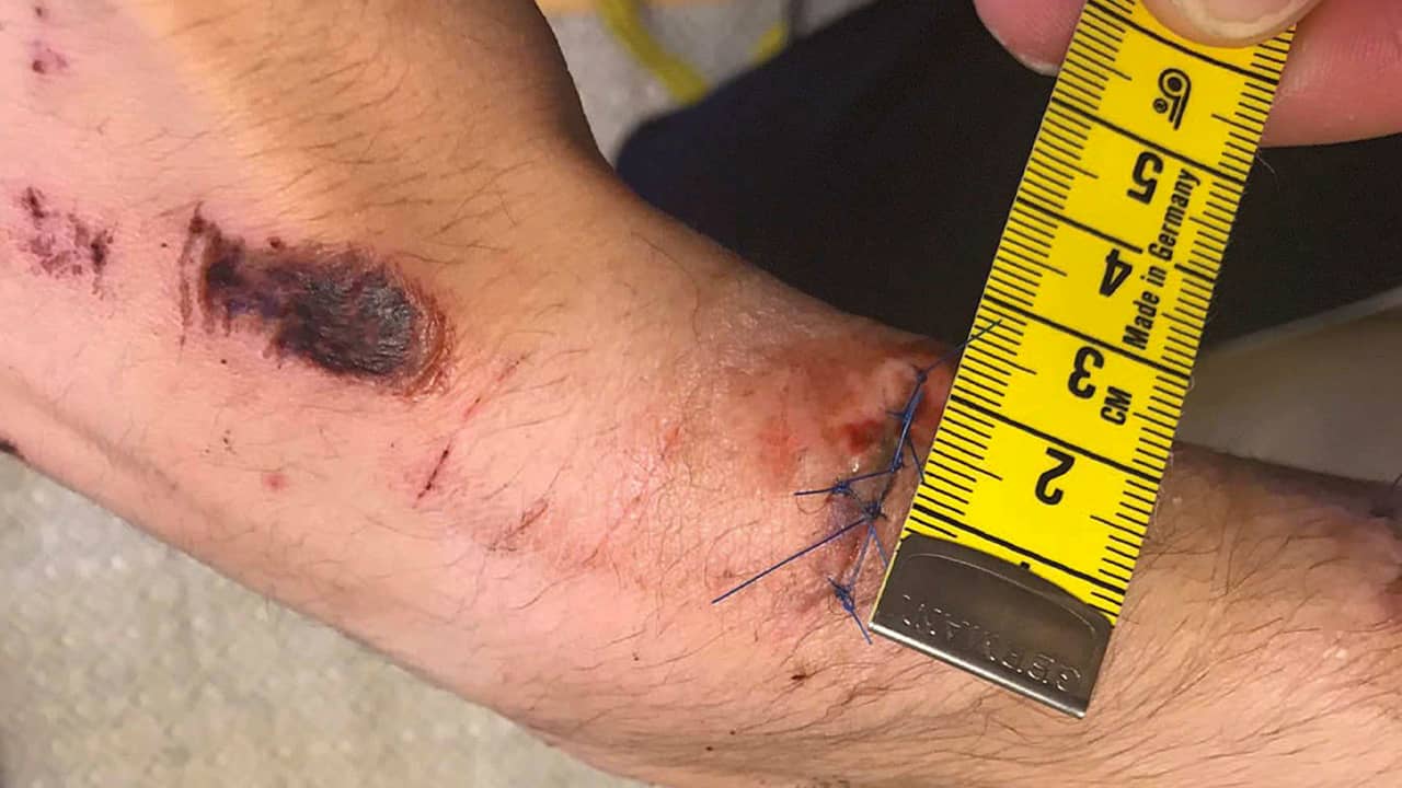 Photo of an injury sustained by Mustafa Jafari, the alleged victim involved in a fight with rapper A$AP Rocky