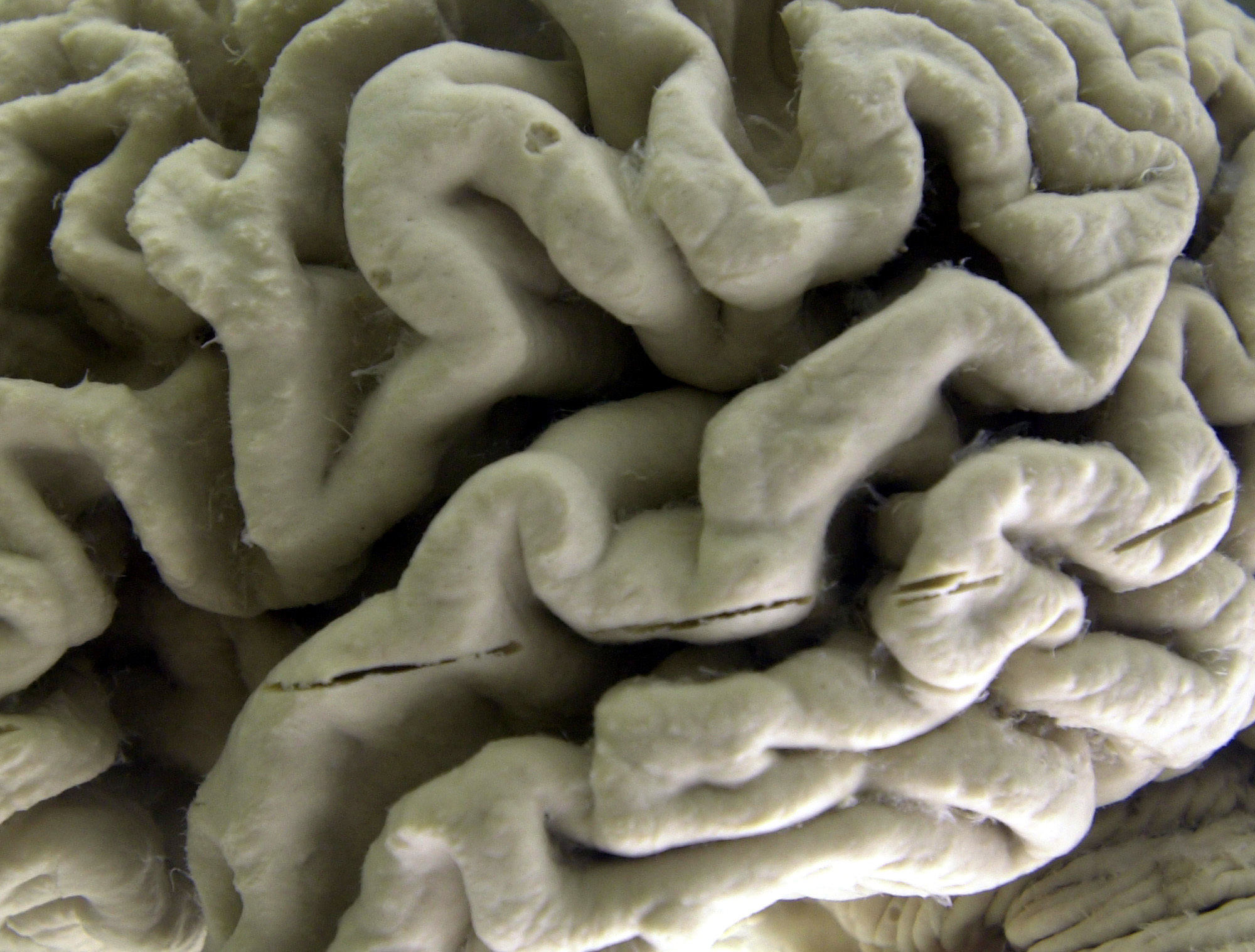 Photo of a brain section with Alzheimer's disease