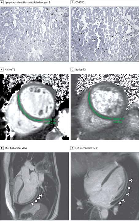 https://jamanetwork.com/journals/jamacardiology/fullarticle/2768916
