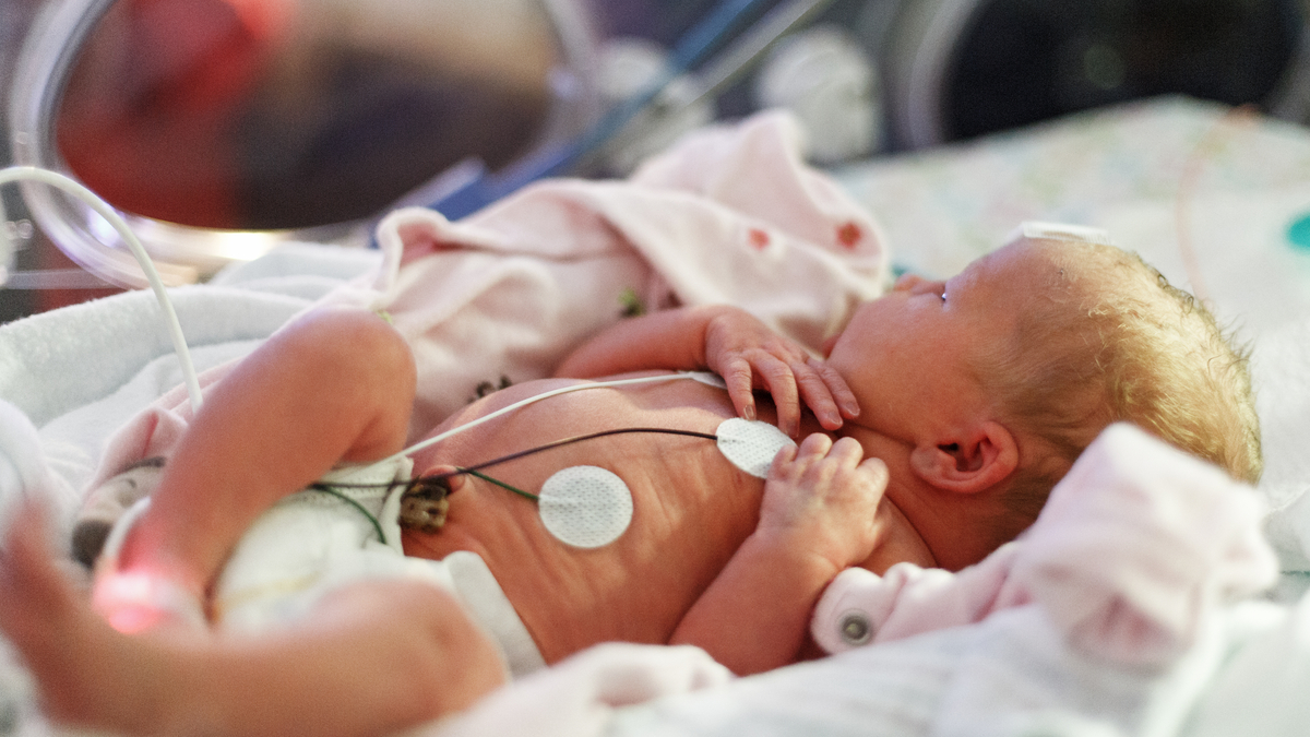 Photo of a premature baby in NICU