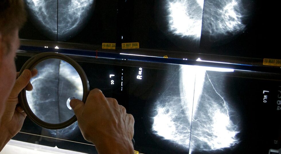 Mammograms-Explainer