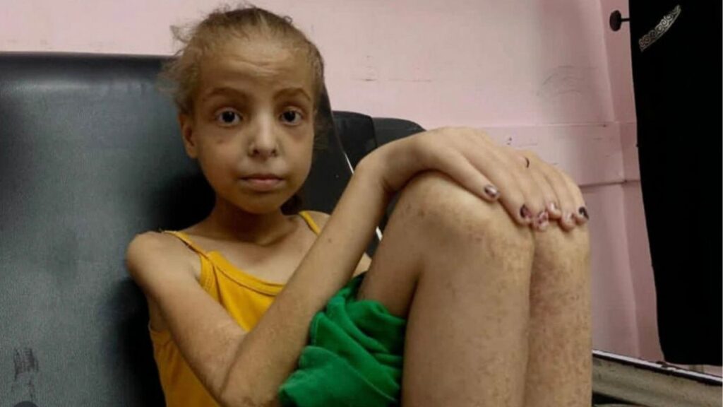 In an image provided by her family, Hoda Abu al-Naja, 12, in a hospital and suffering from malnutrition in July 2025. After Israel sealed Gaza’s borders, Hoda who suffered from celiac disease, spent months seeking the food and care she needed to combat malnutrition. (Abu al-Naja family via The New York Times)