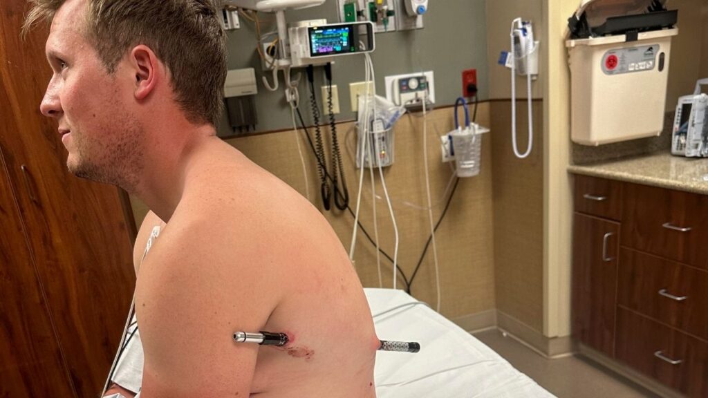 A photo provided by David Cifaldi shows him sitting with part of a trekking pole stuck through his left side at the hospital where he works as a wound nurse in Billings, Mont. Cifaldi was hiking up Granite Peak, Montana’s tallest mountain last week when he slipped and fell on one of his trekking poles. A wound nurse, he went into survival mode. (David Cifaldi via The New York Times)